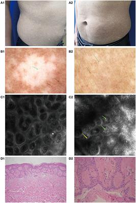 Case Report: Amyloidosis Cutis Dyschromica: Dermoscopy and Reflectance Confocal Microscopy and Gene Mutation Analysis of a Chinese Pedigree